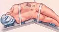 <b>Nephrectomy</b>
