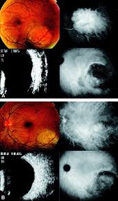ScienceDirect.com - Ophthalmology - Giulio Porrini, Alfonso Giovannini, Giampaolo Amato, Alfonso Ioni, Marco Pantanetti - 1-s2.0-S0161642002019681-gr3