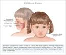 <b>Mumps</b> is a contagious viral