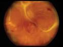 <b>retinal necrosis syndrome</b>.