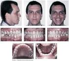 <b>Maloclusión</b> De <b>Angle Clase</b> Iii