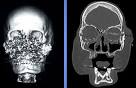 A CT scan of Connie Culp's face before and after the transplant - skull_1397490i