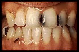 تسوس الاسنان Dental Caries Images?q=tbn:ANd9GcQL4ZGj8nF6B3HkKPcomFAedKSLd0VuF%20%20G-cIH53GOBXwbcGvj67&t=1