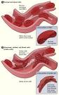What Is Sickle Cell Anemia? - NHLBI, NIH