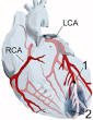 <b>Infarto do miocárdio</b> na ponta