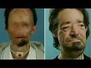 Face transplant for 'zombie' victim? First comes simple survival ...