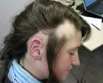 Areata <b>alopecia</b> is a form of