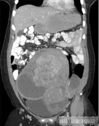 Image result for CT 扫描: 骨盆的, 盂的: 异常的