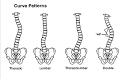 Does <b>Scoliosis</b> Have to Be