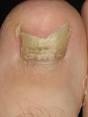 affected by <b>onychomycosis</b>