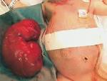 <b>Autosomal recessive polycystic</b>