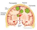 <b>meningiomas</b>