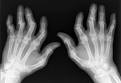 <b>Psoriatic Arthritis</b>is one of