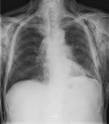 <b>mediastinal emphysema</b>.
