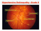 <b>Malignant hypertension</b>