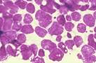 <b>Non Small Cell Lung Carcinoma</b>