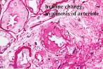 Benign <b>Nephrosclerosis</b> 1