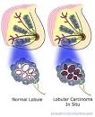 <b>Lobular carcinoma</b> of the