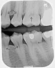 of <b>secondary dentin</b>;