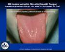 Atrophic <b>glossitis</b> (iron