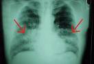 Fibrosi <b>polmonare</b> idiopatica.