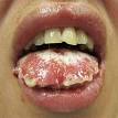 <b>Stevens</b>–<b>Johnson syndrome</b>