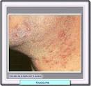 La <b>foliculitis</b> producida por