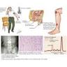 <b>Amyloid Neuropathy</b>