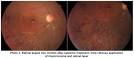 ARN is a very rare <b>syndrome</b>