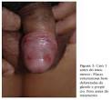 <b>Doenças</b> Sexualmente