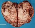 (El <b>Tumor de Wilms</b> es la 5