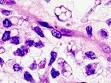 de <b>liposarcoma mixoide</b>.