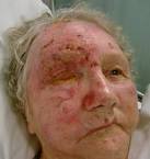 <b>Herpes zoster ophthalmicus</b>