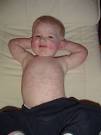 what Fifth <b>disease</b> is and