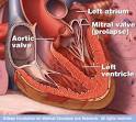 <b>Mitral Valve Prolapse</b>