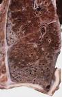 Silag <b>Asbestose</b>