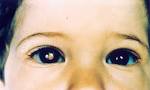 File:<b>Retinoblastoma</b>.jpg