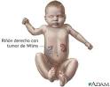 <b>Tumor de Wilms</b>
