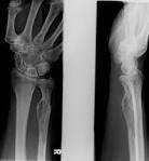 <b>Osteosarcoma</b>