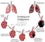 Smoking and <b>Emphysema</b> Stock