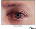 When <b>conjunctivitis</b> is
