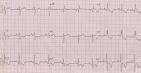 <b>Right ventricular hypertrophy</b>