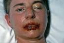 photo <b>stevens johnson syndrome</b>