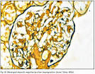 Axoval <b>neuropathy</b> as