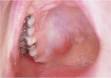 <b>adenoma</b>, <b>acidophilic</b>,