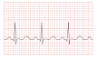 <b>Tachycardia</b> ECG paper.svg