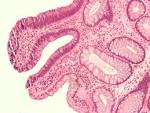 File:Tubular <b>adenoma</b> high mag.
