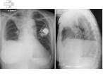 -<b>pleuresie</b>-pacemaker