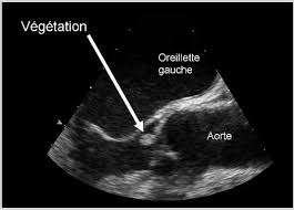 Image result for Échocardiographie transthoracique: Végétations valvulaires