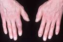 of <b>psoriatic arthritis</b>